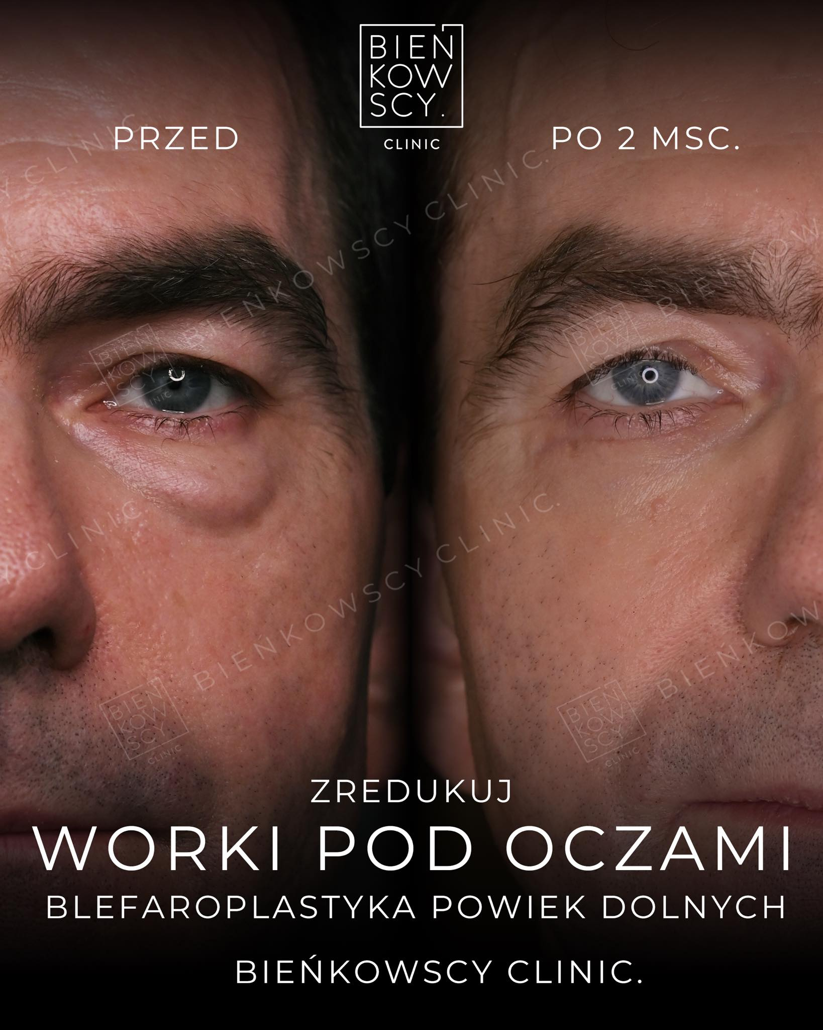 Pozbądź się worków pod oczami dzięki nowoczesnej medycynie estetycznej. Bieńkowscy Clinic Bydgoszcz, Częstochowa
